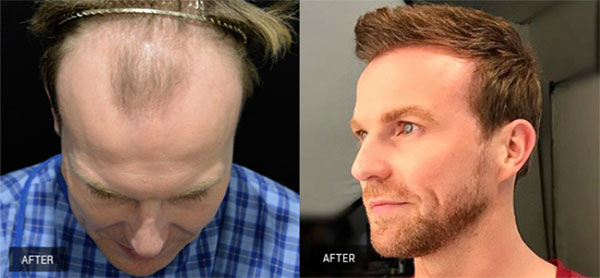 ba1 | Hair-loss Client Transformations | 3