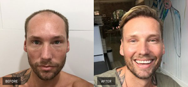 ba2 | Hair-loss Client Transformations | 5