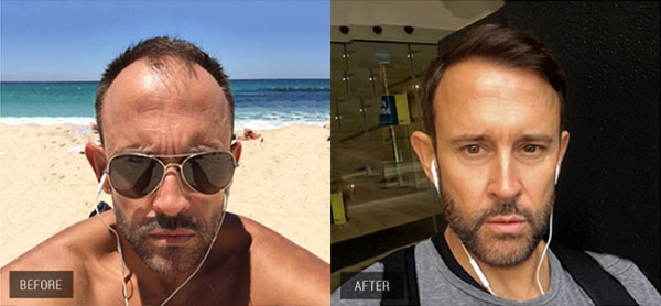 ba3 | Hair-loss Client Transformations | 7