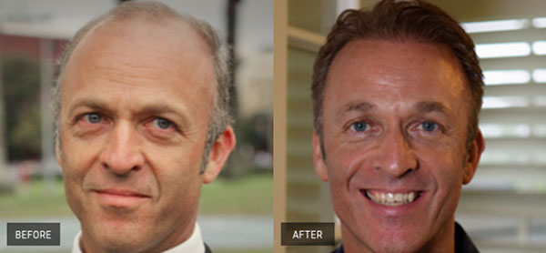 ba4 | Hair-loss Client Transformations | 9